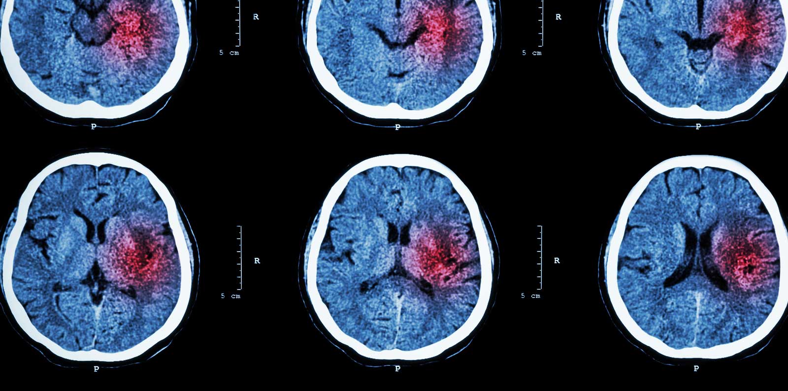 Cerebral Hemorrhage Treatment In Miami Florida By Neurosurgeon